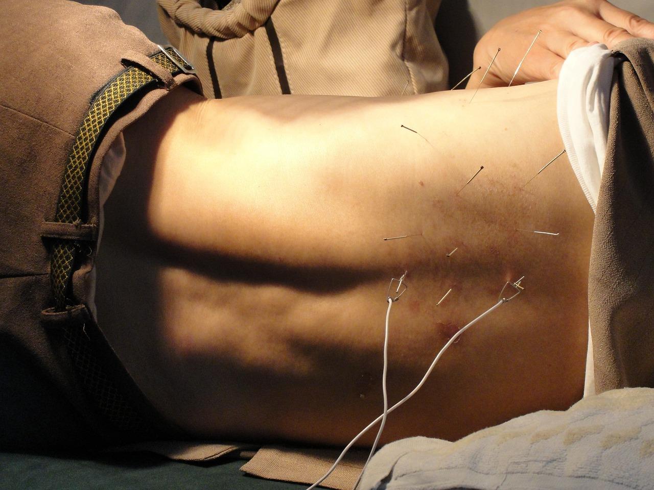 Een man wordt behandeld met acupunctuur in Roosendaal